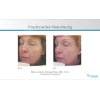 fractional skin resurfacing example 1, your results may vary