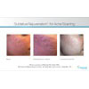 acne treatment, sublative rejuvenation for acne scarring 2, your results may vary