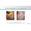 acne treatment, sublative rejuvenation for acne scarring 3, your results may vary