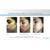 acne treatment, sublative rejuvenation for acne scarring 4, your results may vary