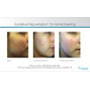 acne treatment, sublative rejuvenation for acne scarring 1, your results may vary
