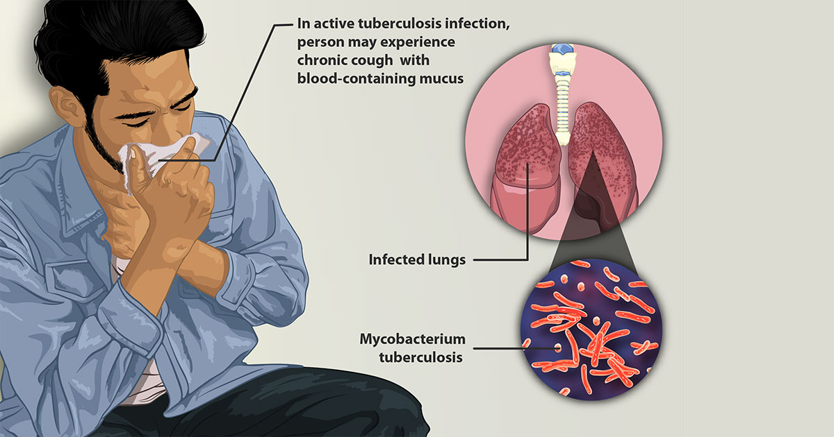 Diagram of man with tuberculosis and mycobacteria infecting lungs.