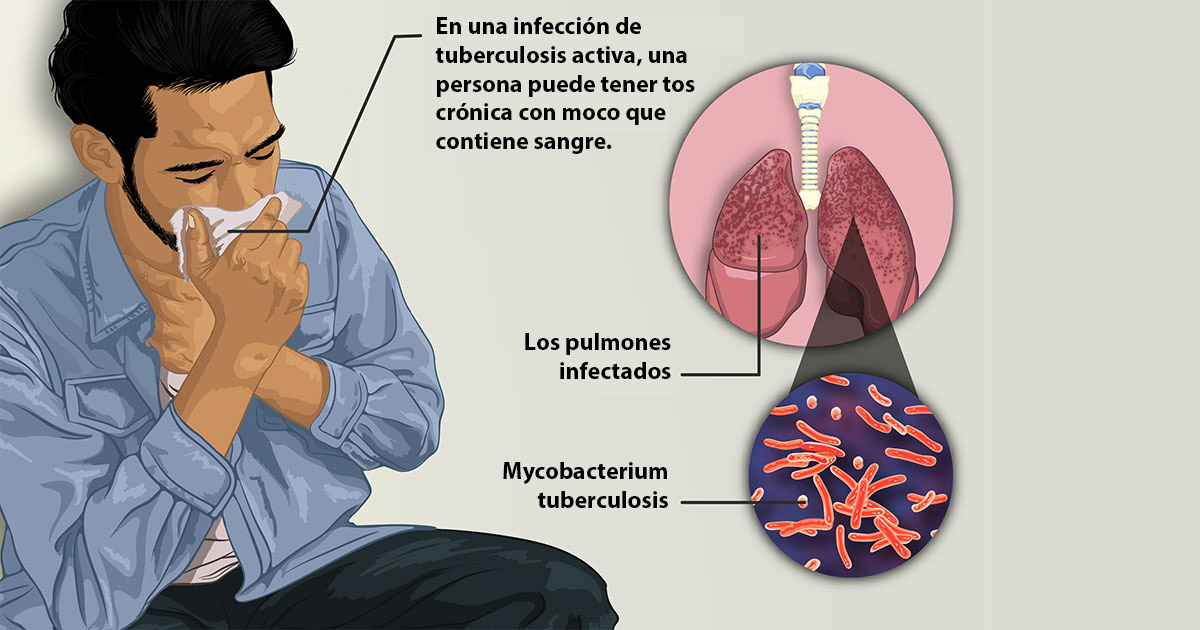 Diagrama de hombre con tuberculosis y micobacterias que infectan los pulmones.