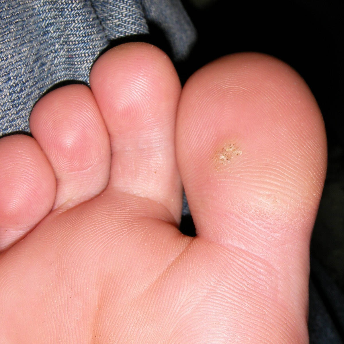 wart on the sole of a foot