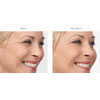 Botulinum Toxin (Botox/Xeomin) crow's feet example 1, your results may vary