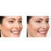 Botulinum Toxin (Botox/Xeomin) crow's feet example 3, your results may vary