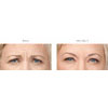 Botulinum Toxin (Botox/Xeomin) frown lines example 1, your results may vary