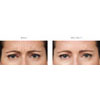 Botulinum Toxin (Botox/Xeomin) frown lines example 3, your results may vary