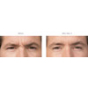 Botulinum Toxin (Botox/Xeomin) crow's feet example 4, moderate to severe, your results may vary
