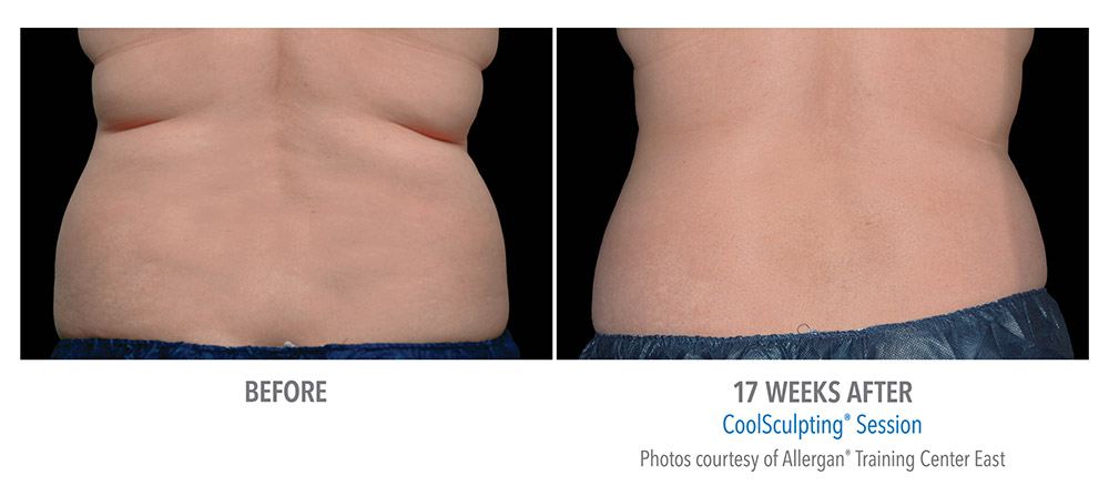 example of female CoolSculpting session before and after 17 weeks shows noticeable reduction of fat, your results may vary, photos courtesy of Allergan Training Center East.
