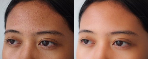 antes y después del tratamiento del acné en el rostro.