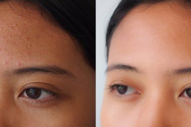 面部痤疮治疗前后对比。