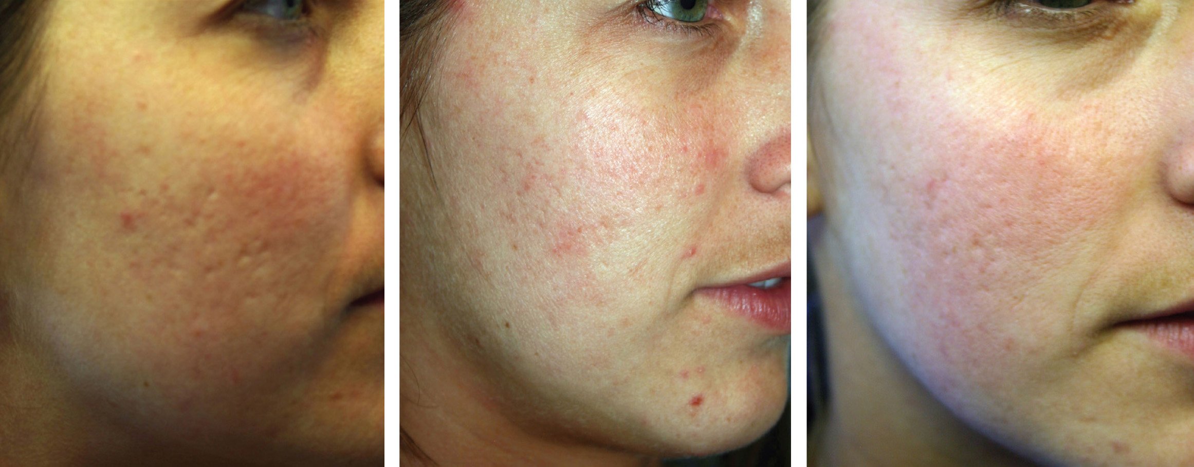 photos taken over time show progressive fading of acne scarring.