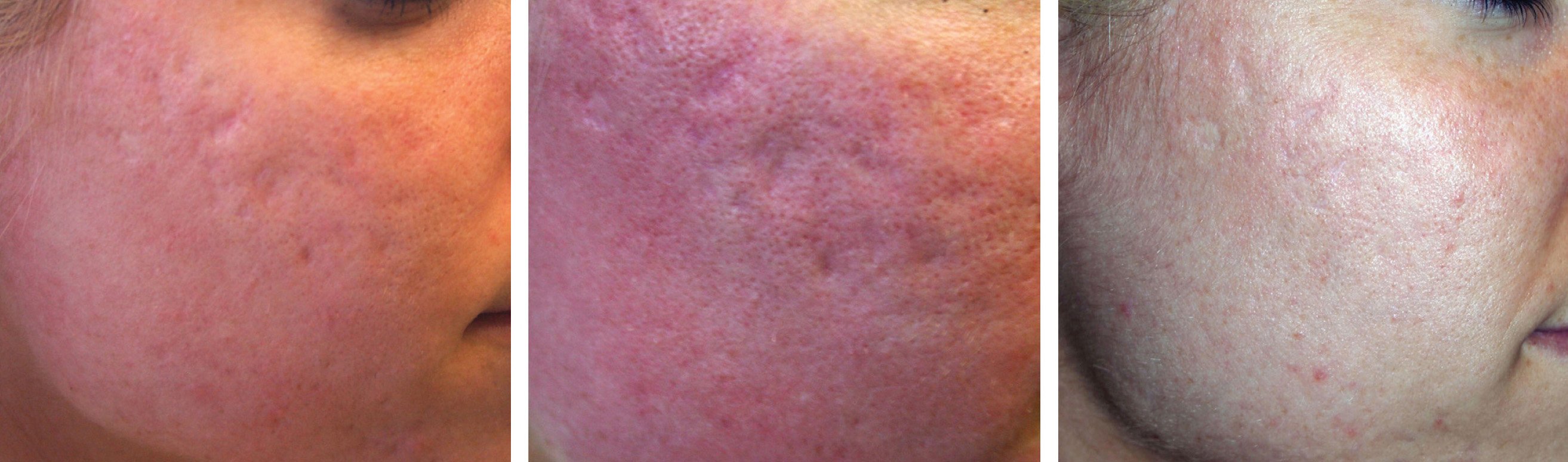 photos taken over time show progressive fading of acne scarring.