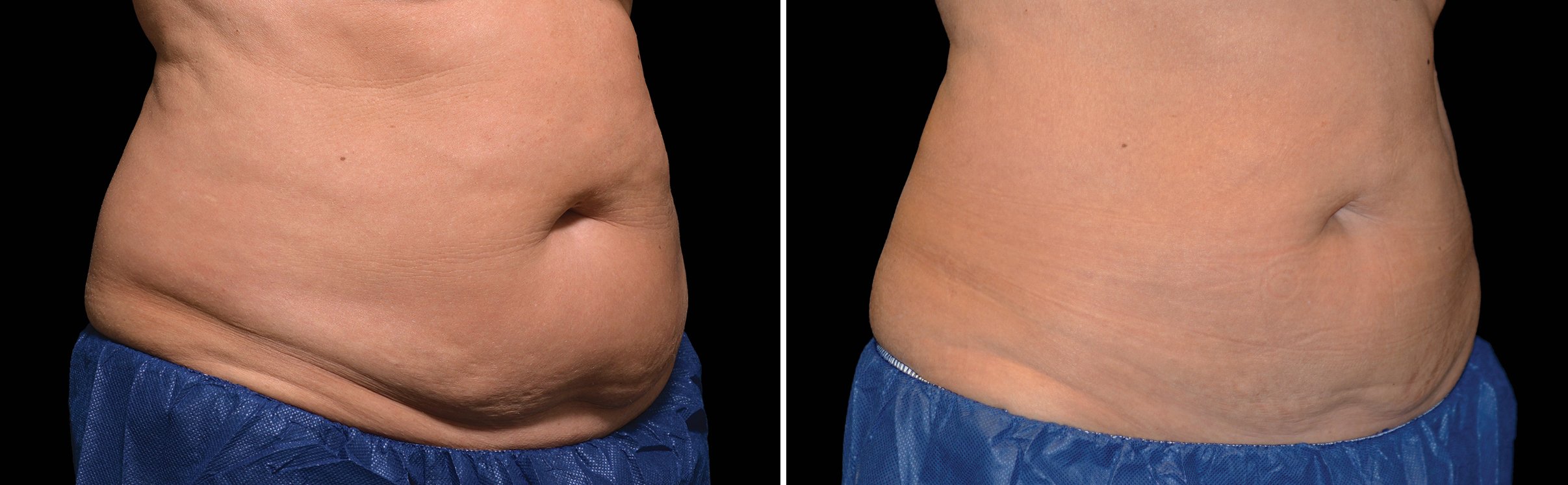photos taken over time show progressive reduction of fat.