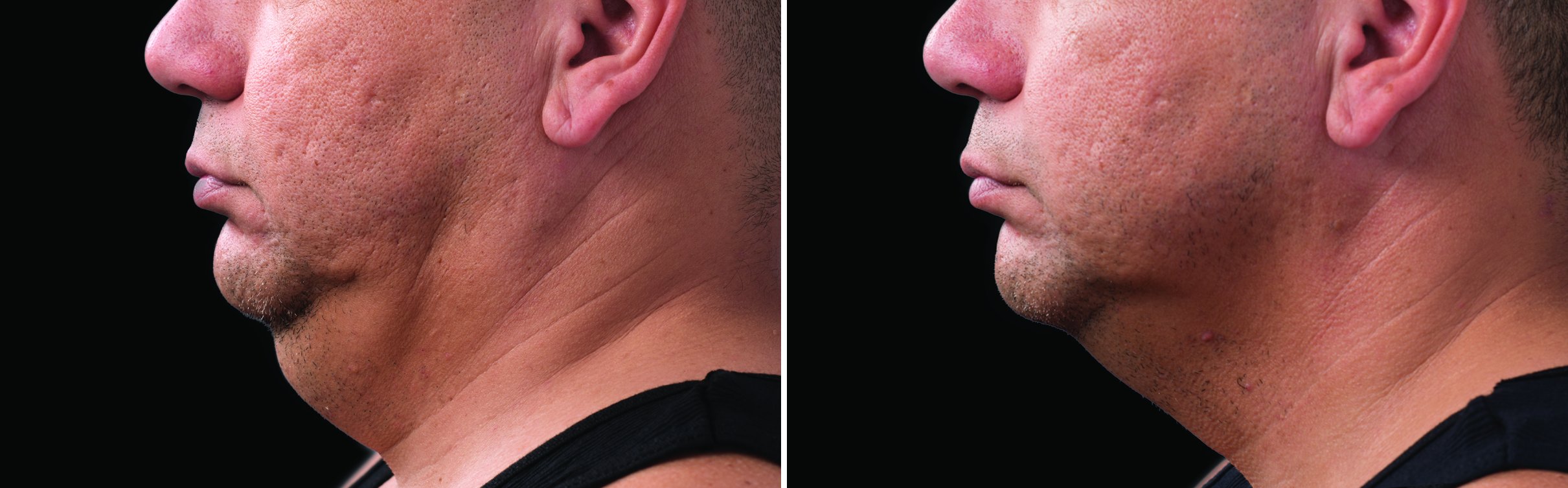 photos taken over time show progressive reduction of fat.