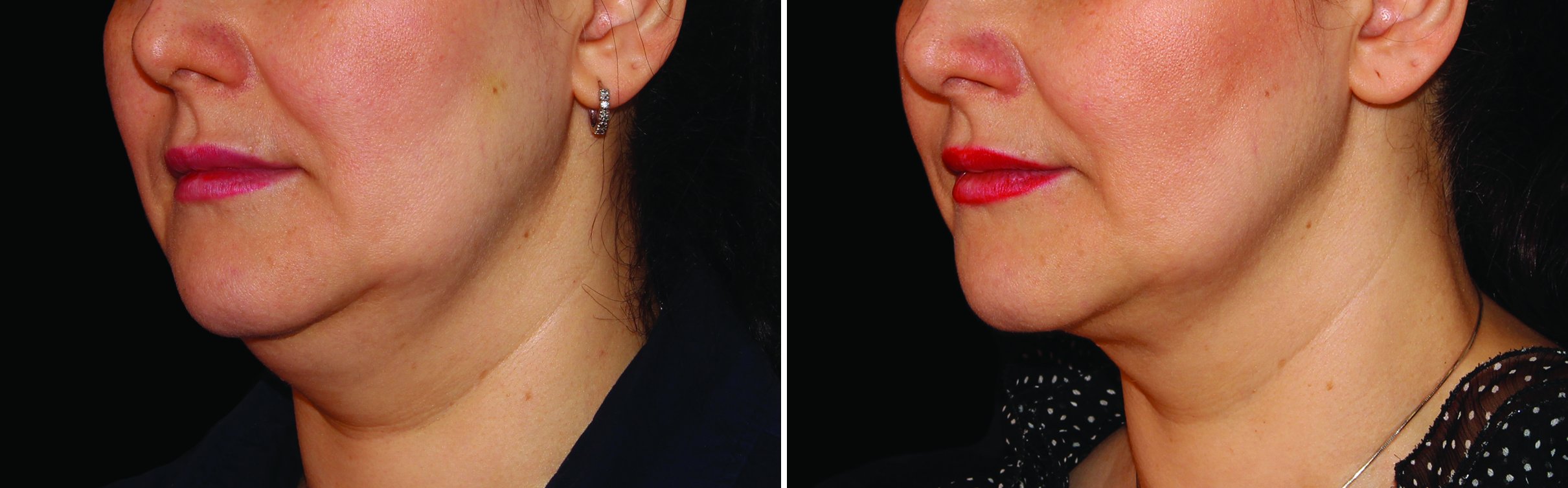 photos taken over time show progressive reduction of fat.