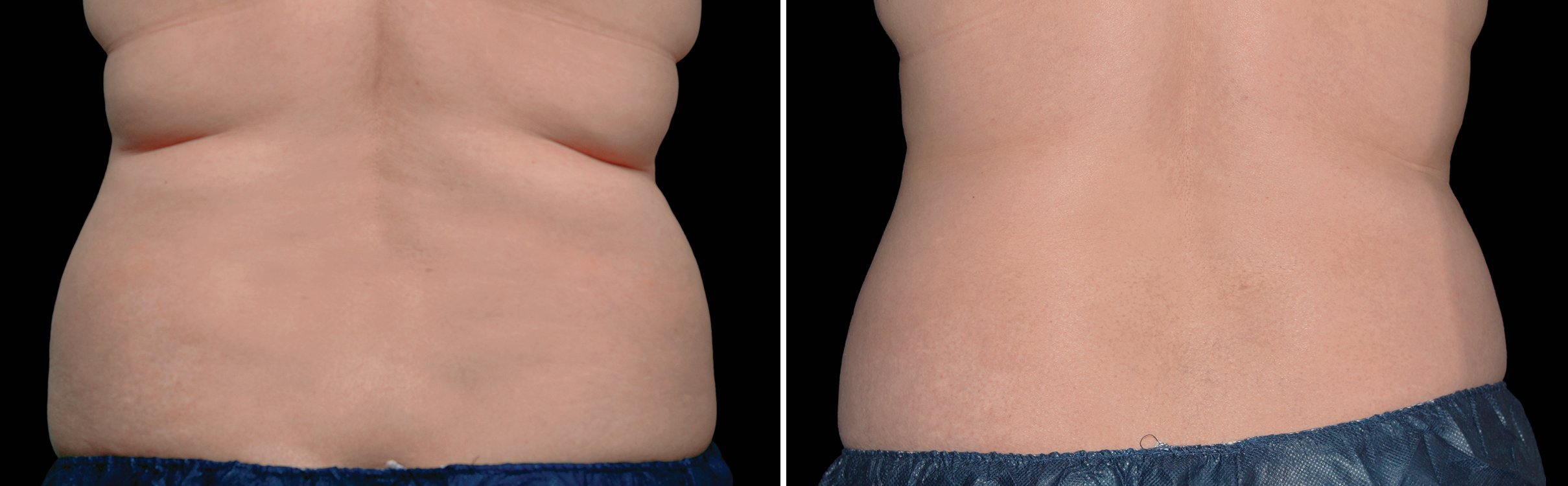 photos taken over time show progressive reduction of fat.