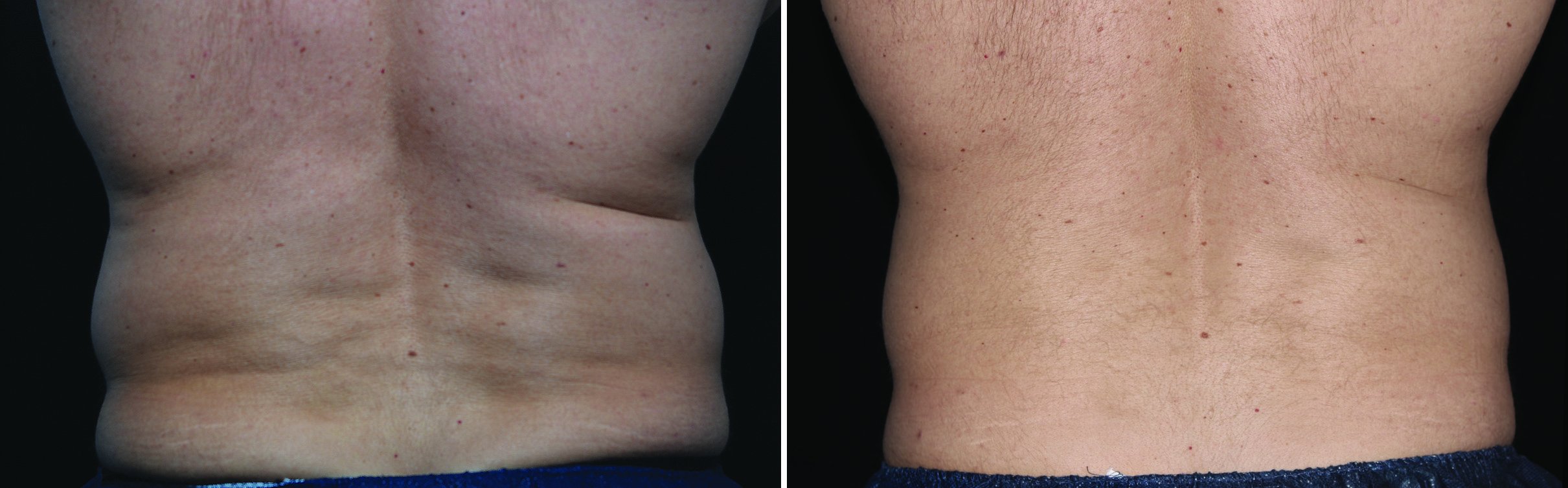 photos taken over time show progressive reduction of fat.