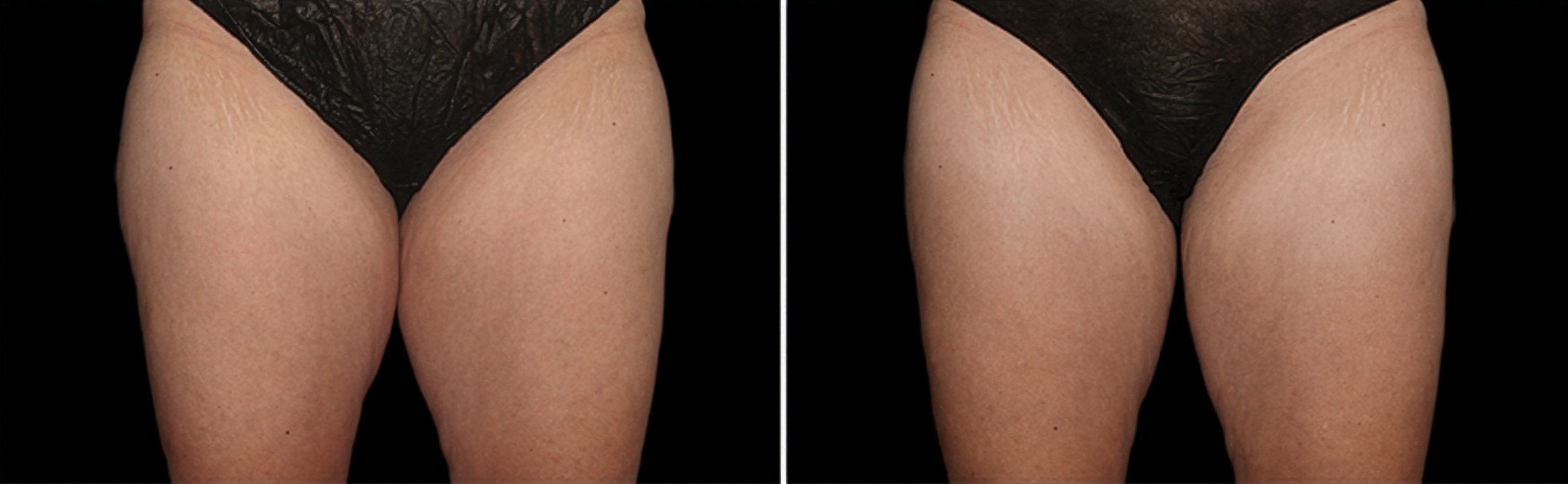 photos taken over time show progressive reduction of fat.