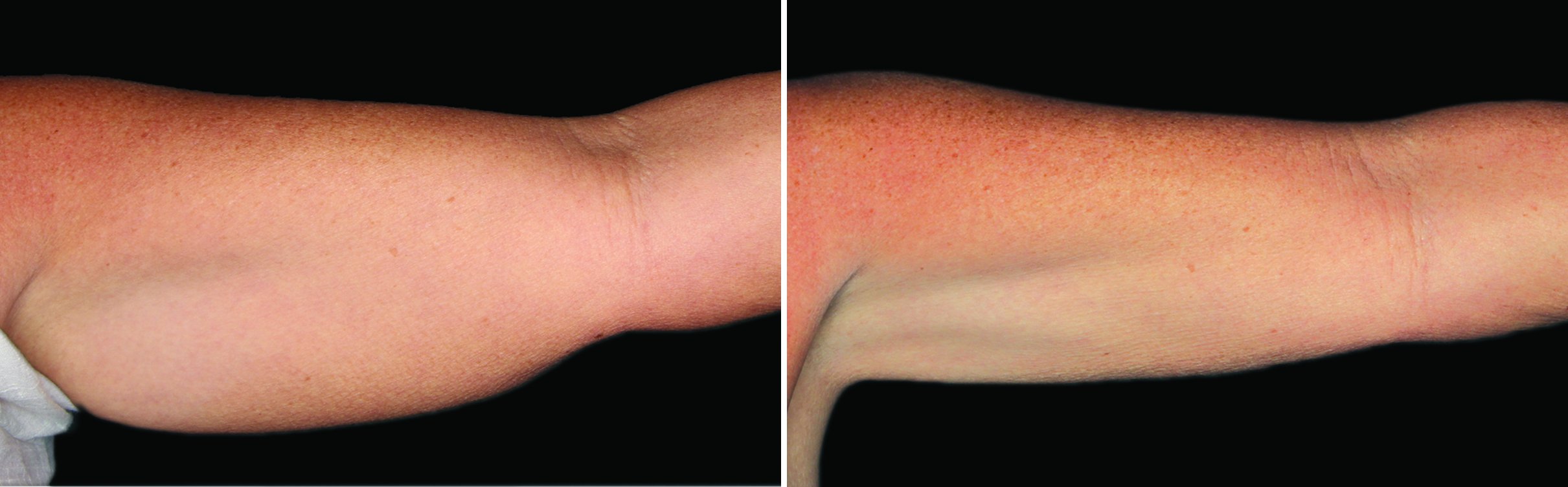 photos taken over time show progressive reduction of fat.