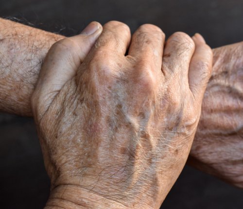 hands and arms with age spots.