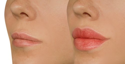 antes y después del tratamiento de labios.