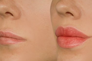 trước và sau điều trị môi.