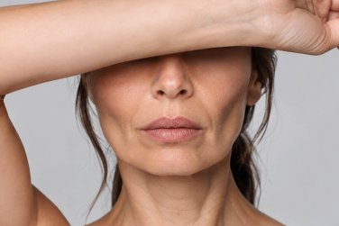 woman with facial volume loss with arm over her eyes.