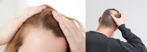 mujer con línea de cabello retraída, hombre con calvicie.