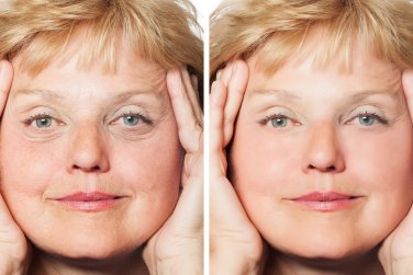 before and after wrinkle-reduction treatment.