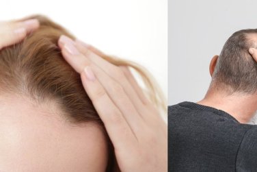 phụ nữ có đường chân tóc lùi, đàn ông hói.