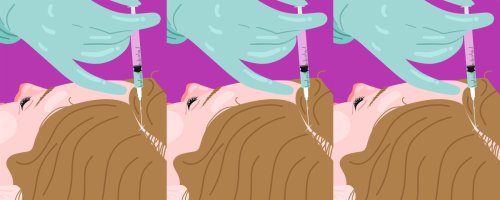 woman receiving PRF injection at hairline.