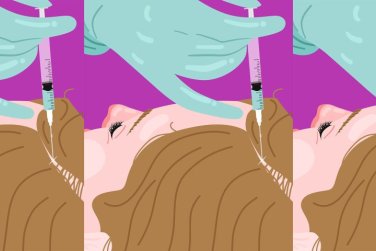 mujer recibiendo inyección PRF en la línea del cabello.