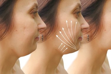 trước và sau thủ thuật nâng cơ bằng chỉ.