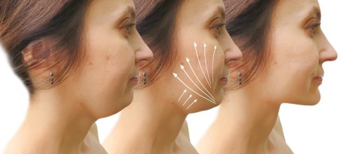 before and after thread lift procedure.