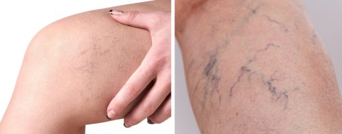 venas varicosas en muslos y piernas.