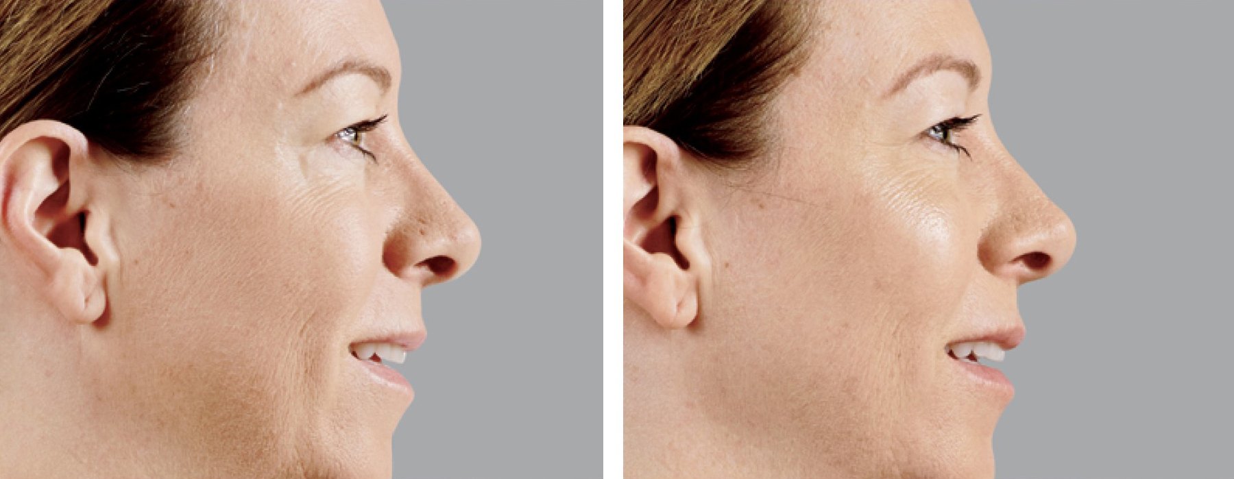photos taken over time show reduction of wrinkles.