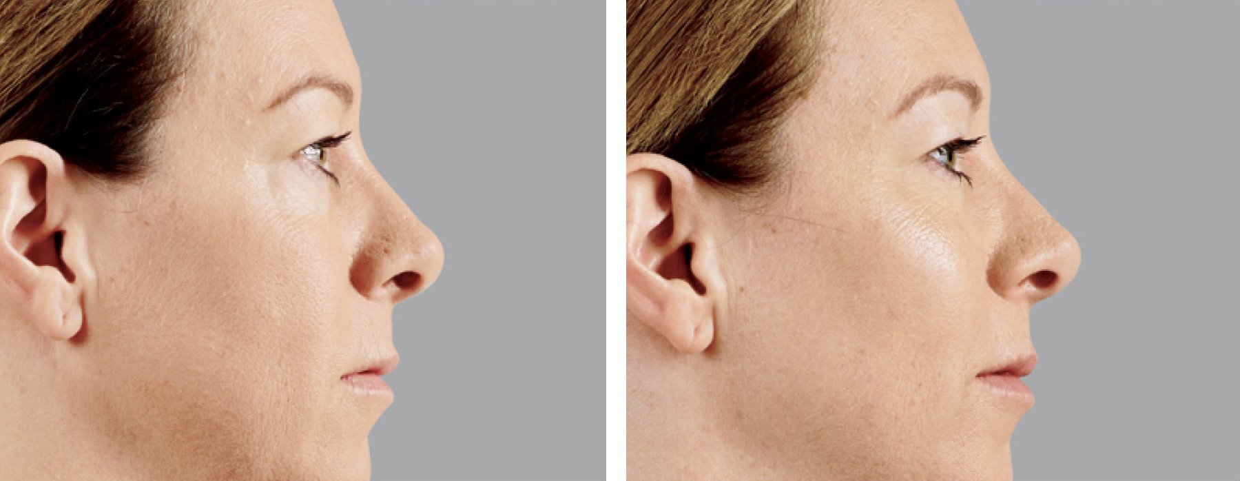 photos taken over time show reduction of wrinkles.