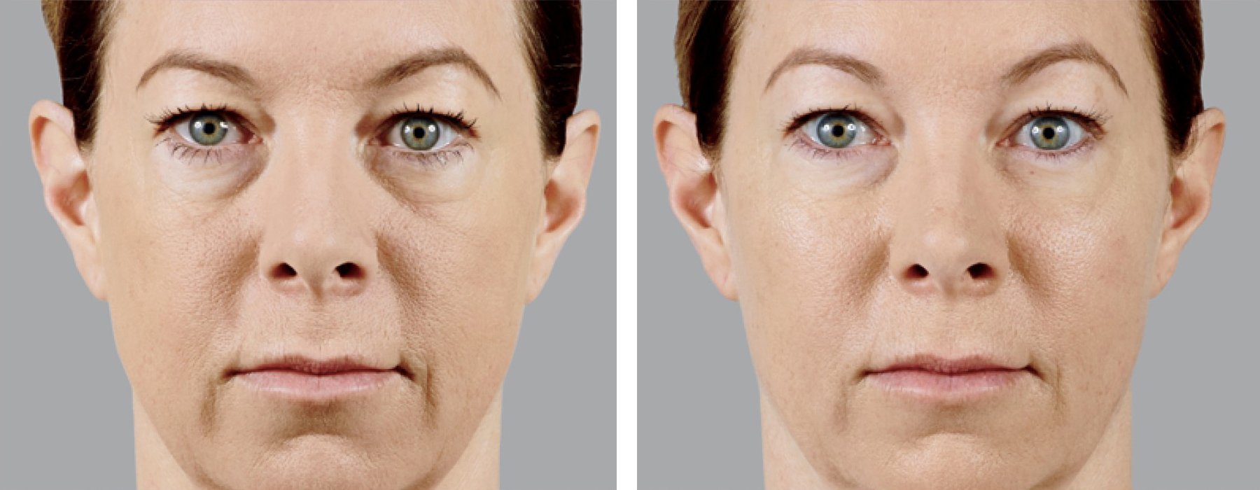 photos taken over time show reduction of wrinkles.