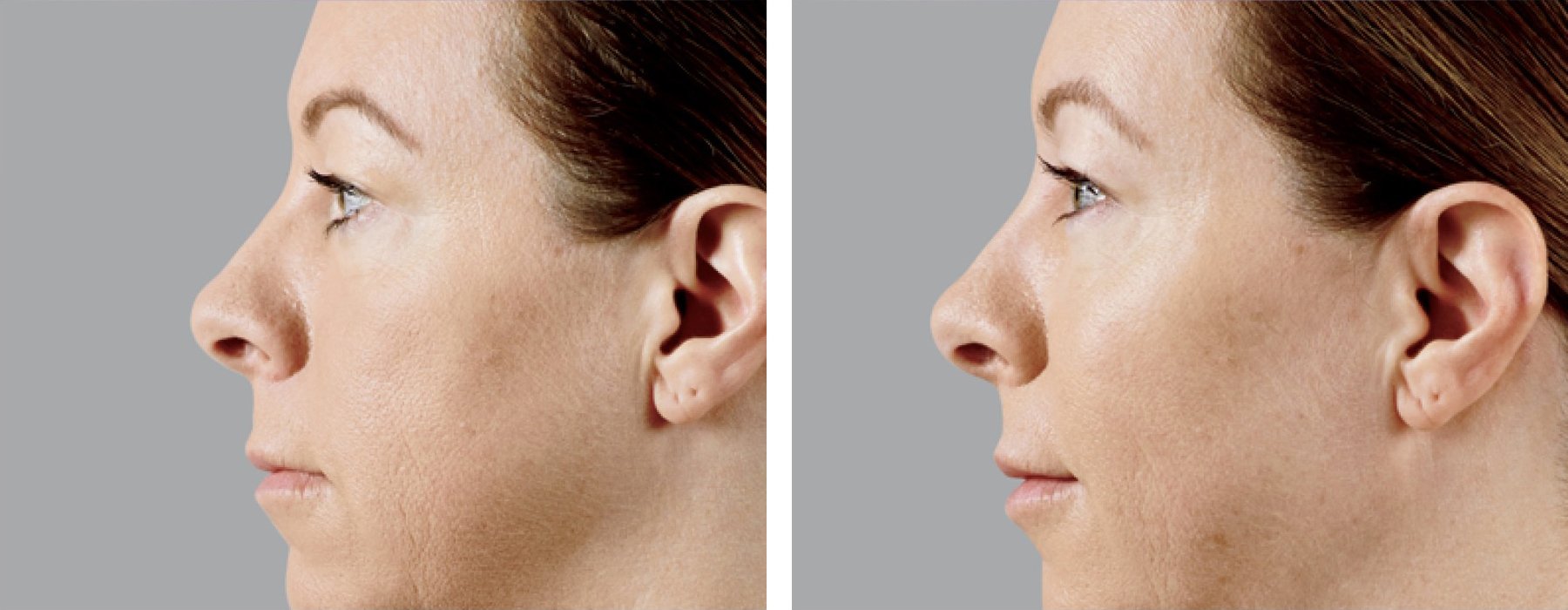 photos taken over time show reduction of wrinkles.